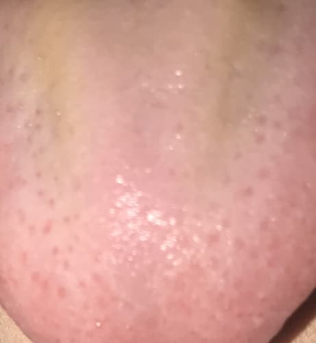 Red bumps on tongue, please help!!