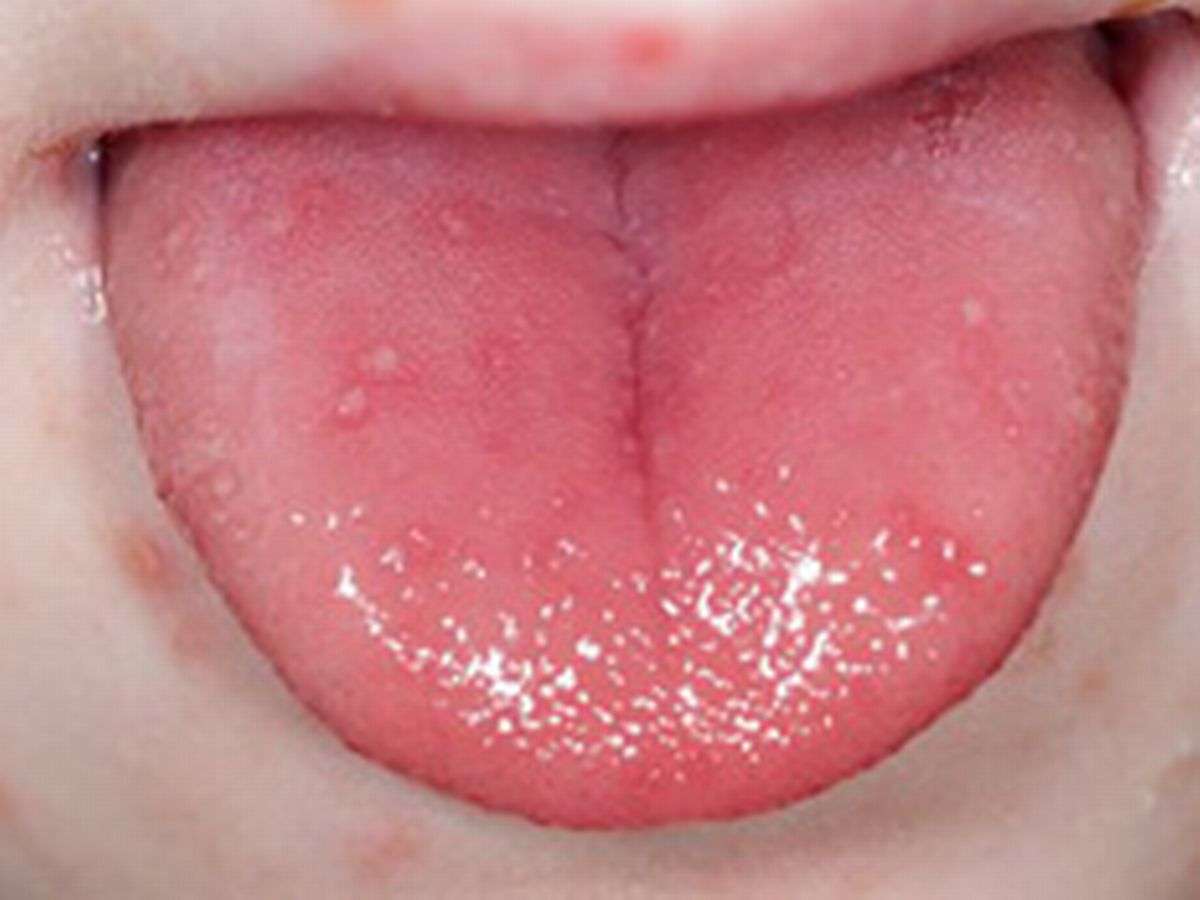 Red Spots On Roof Of Mouth Sore Throat Nhs