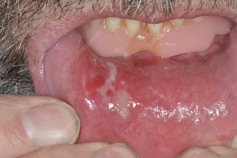 Red Ulcers On Inside Of Lip