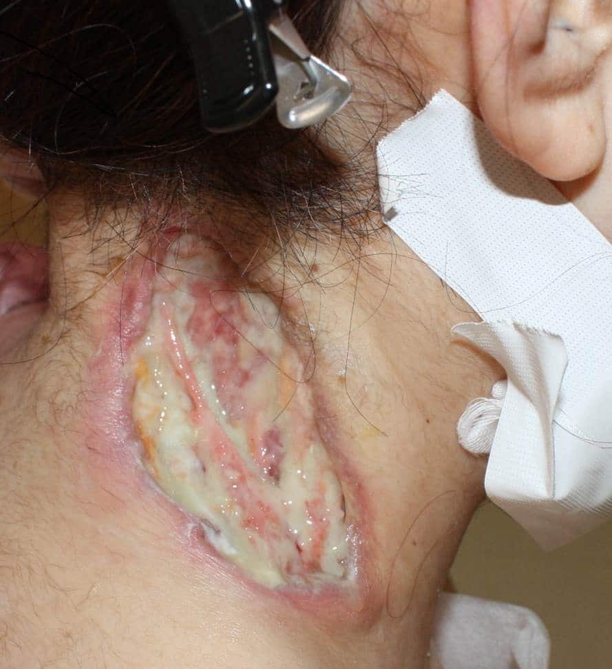 Refractory pyoderma gangrenosum associated with ulcerative colitis ...