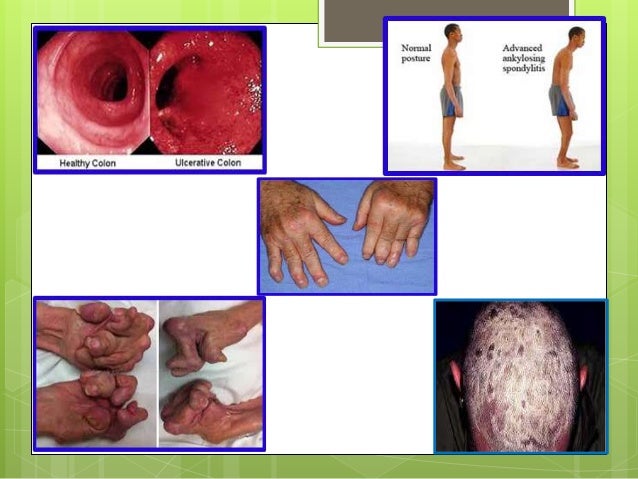 Remicade(Infliximab) presentation