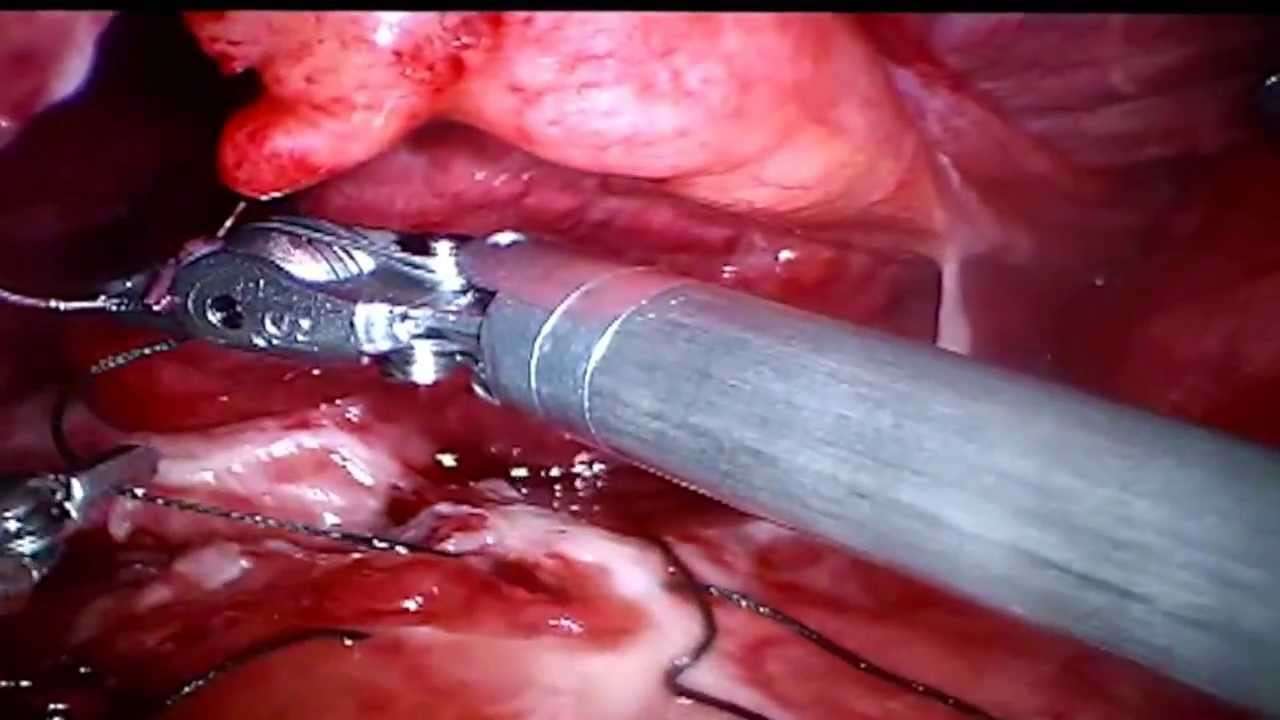 Robotic Repair of Perforated Duodenal Ulcer in a Cirrhotic ...