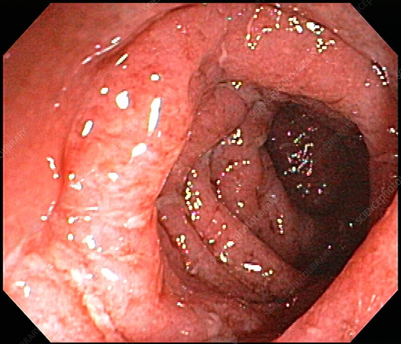 Severe Ulcerative Colitis
