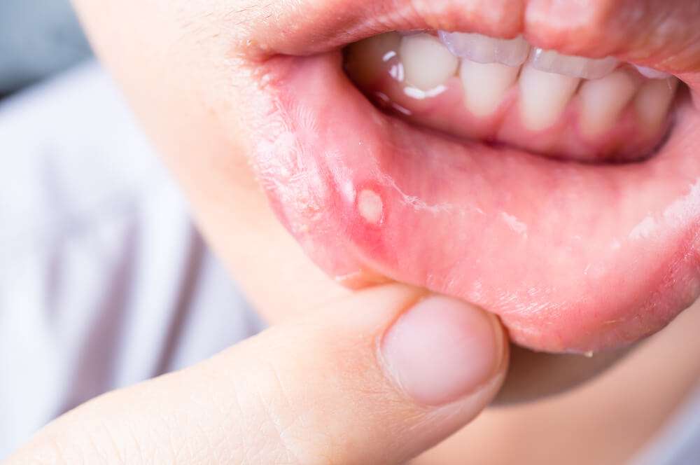 Should I worry about mouth ulcers?