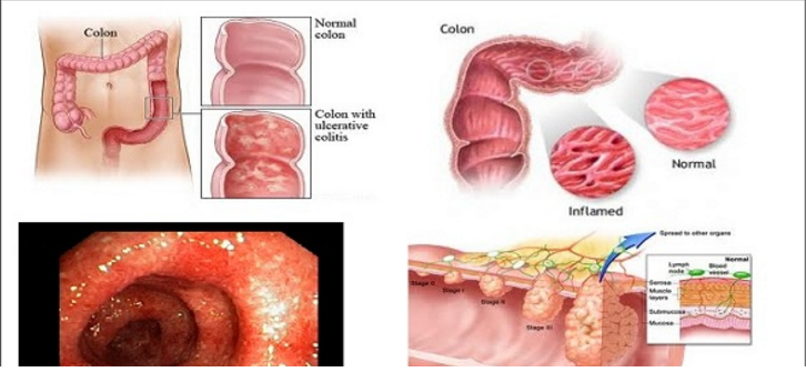 Simple Tips for Dealing with Ulcerative Colitis Flares ...