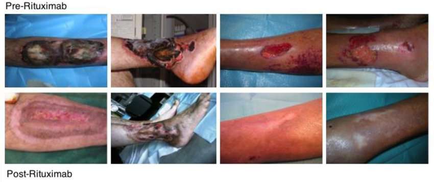 Skin ulcers healing after Rituximab treatment.