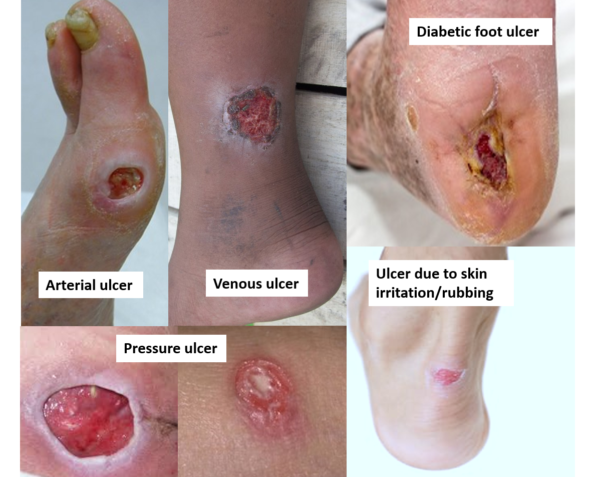Skin Ulcers &  Wound: Causes, Types, Treatment &  Symptoms