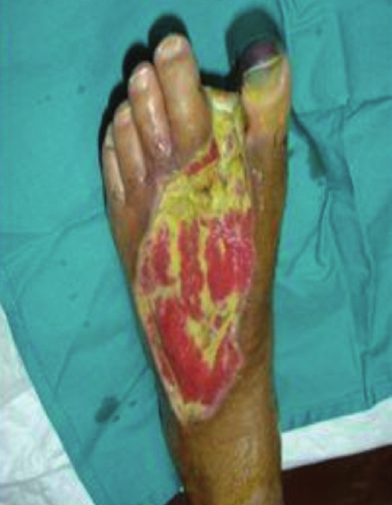 Sloughed diabetic foot wound over dorsum, (a), and skin ...