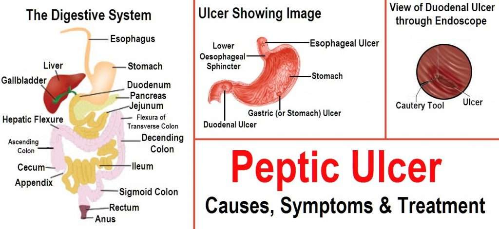 Some strategies how to manage Ulcer