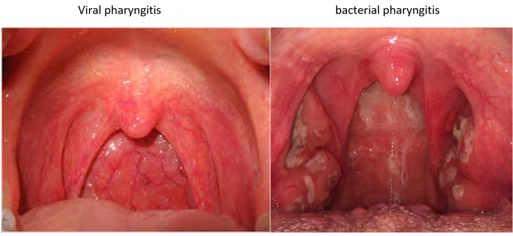 Sore throat: Causes, Symptoms and Health measures