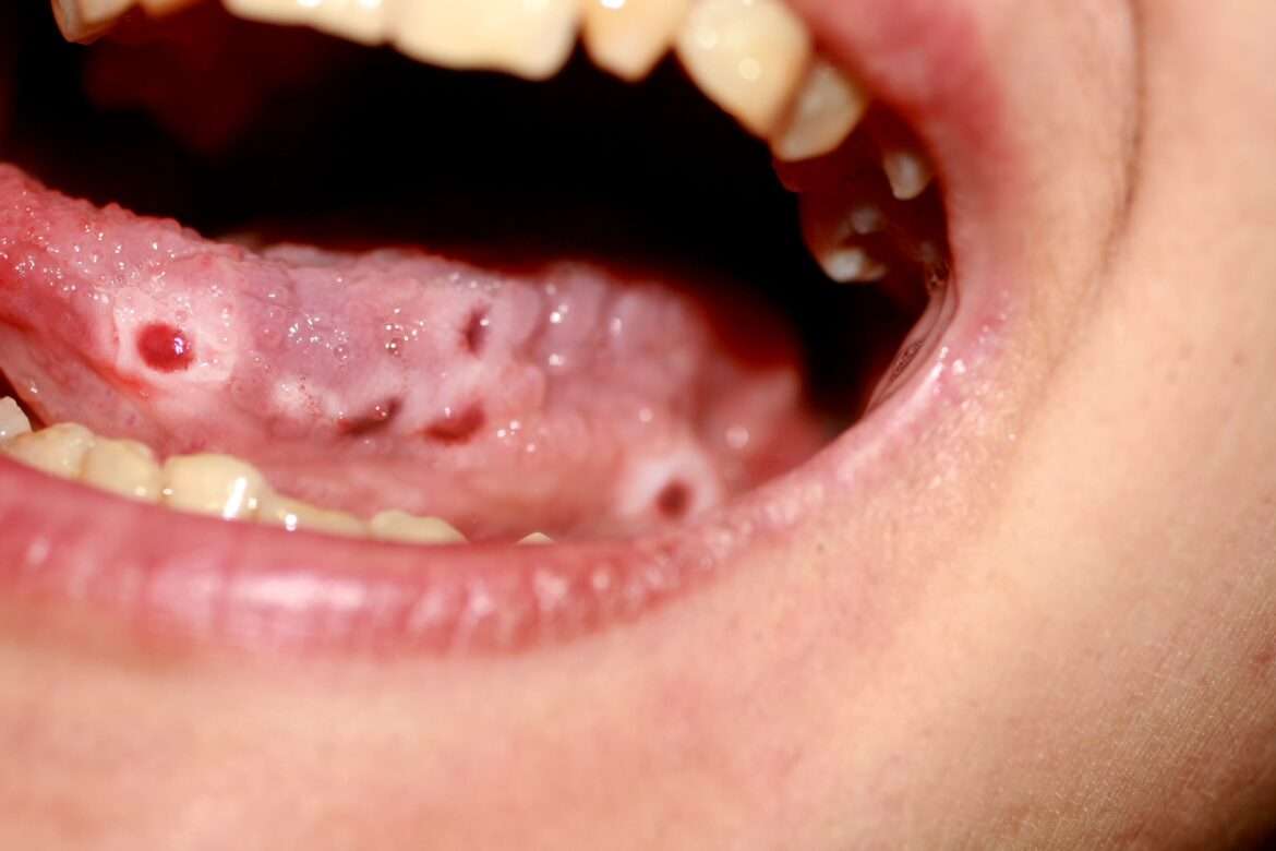 Sores on Back of Tongue or Mouth Causes and Treatment