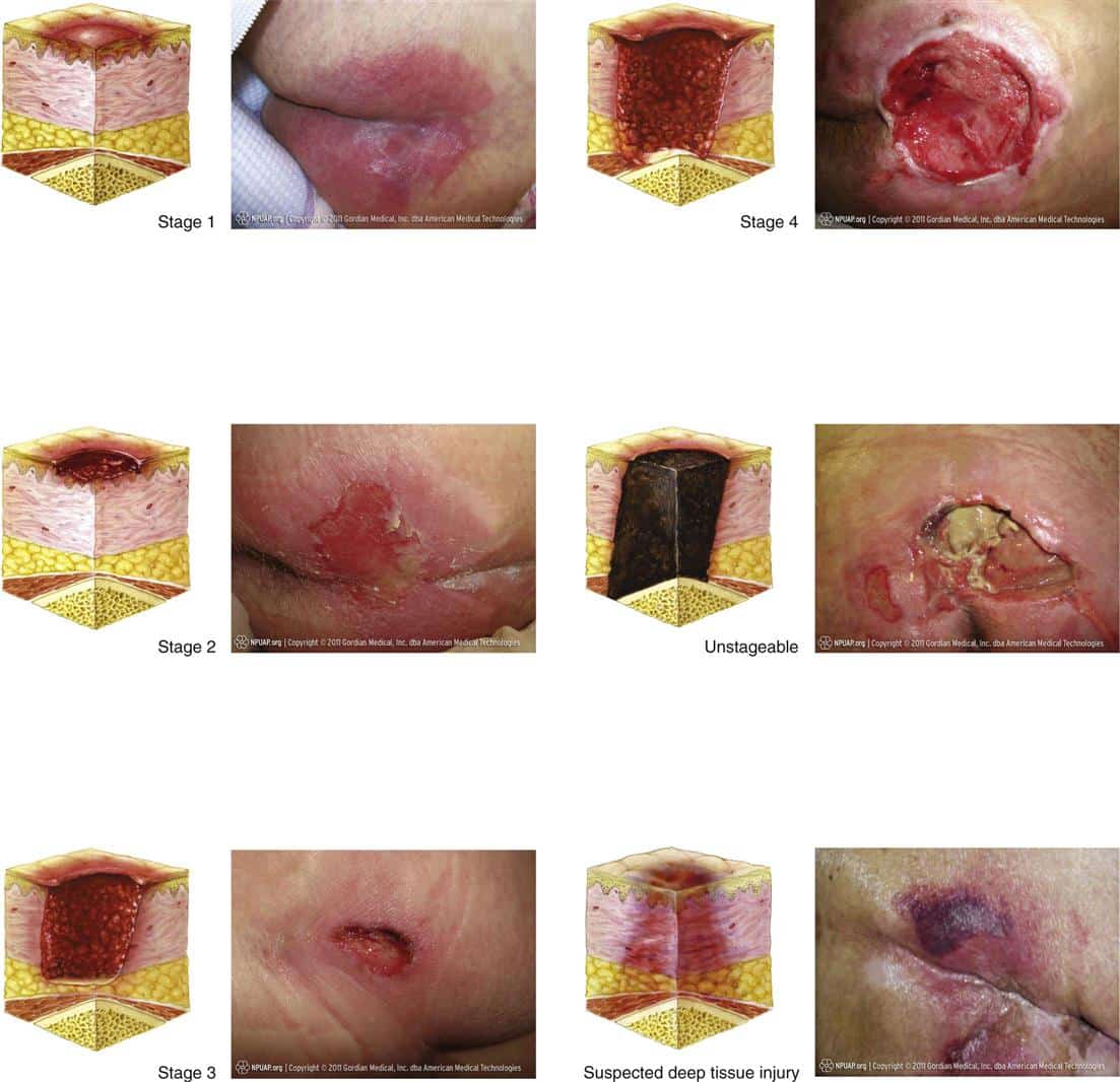 Stage 2 Pressure Ulcer Sacrum