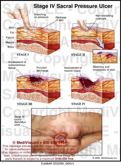 Stage IV Sacral Pressure Ulcer
