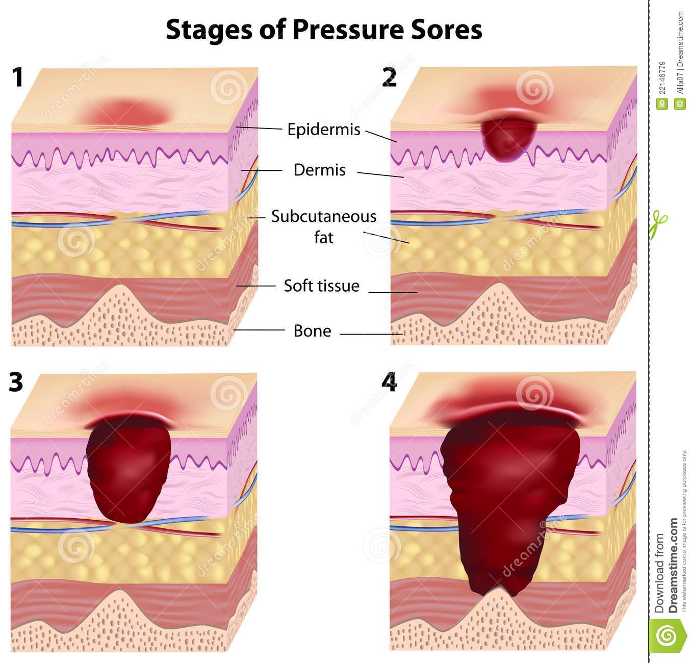 Stages of pressure sores stock vector. Illustration of knee