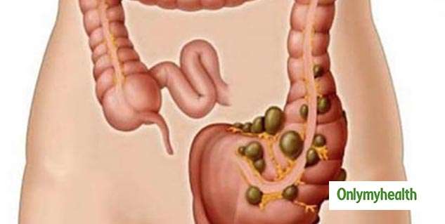 Stomach Pain and Blood in Stool May be Early Sign of Ulcerative Colitis ...