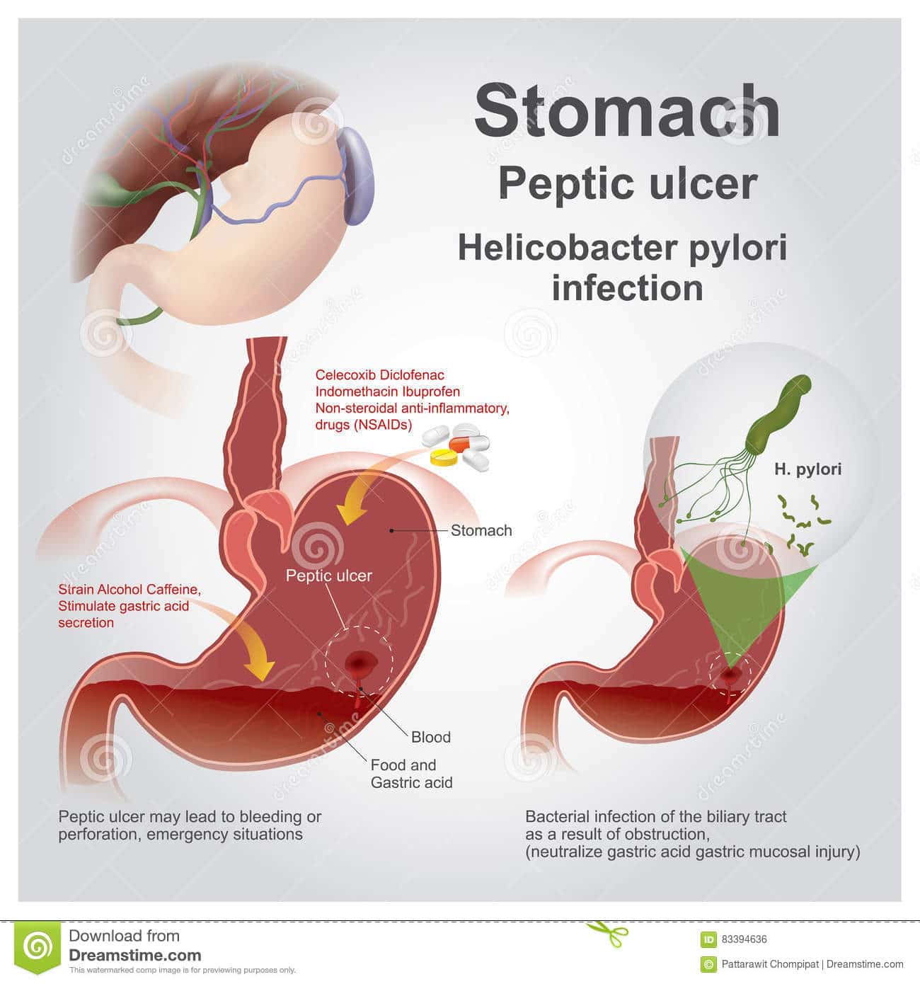 Stomach peptic ulcer. ilustração do vetor. Ilustração de carbonato ...