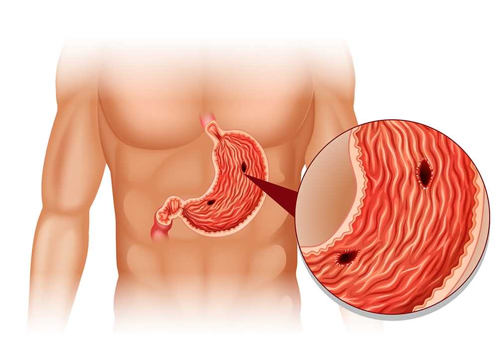 Stomach Ulcer (Gastric Ulcer)  15 Common Signs &  Symptoms
