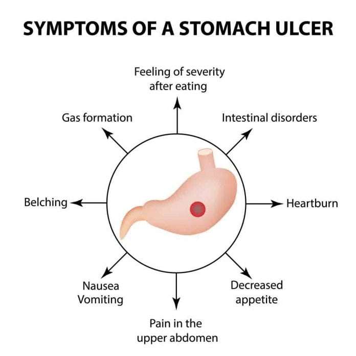 Stomach Ulcer (Gastric Ulcer): (Overview, Signs and Symptoms, Causes ...