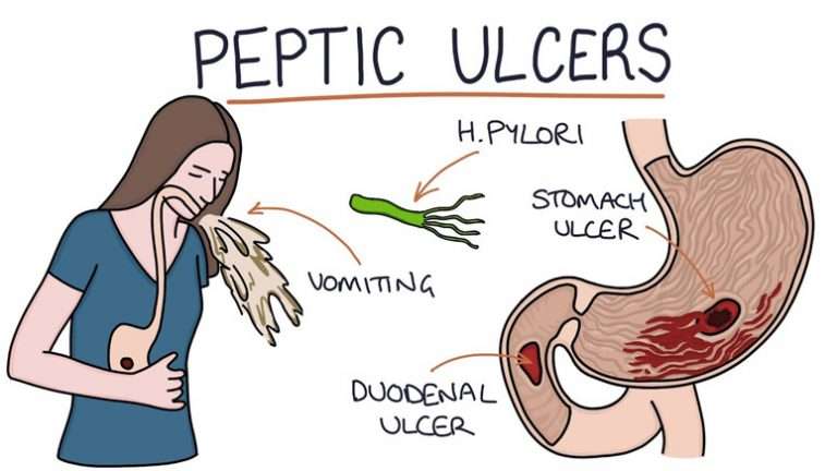 Stomach Ulcer(Peptic Ulcer): Symptoms and Causes â Page 7 ...