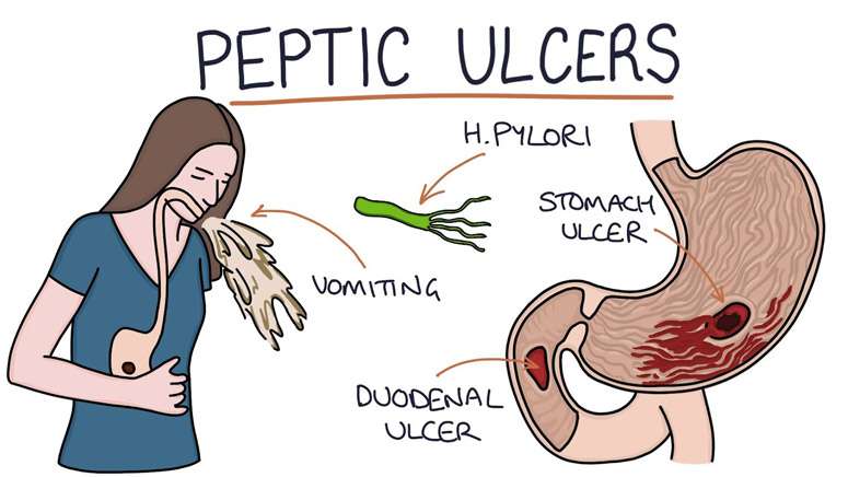 Stomach Ulcer(Peptic Ulcer): Symptoms and Causes ...