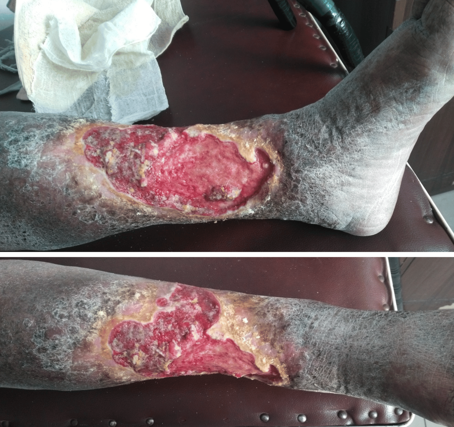 Strategies and challenges in the treatment of chronic venous leg ulcers