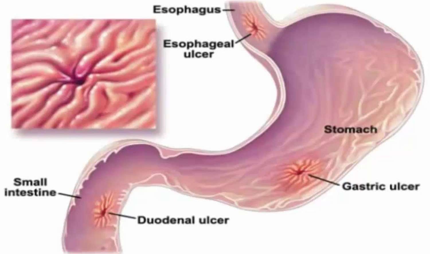 Stress ulcer causes, prophylaxis, symptoms, diagnosis, treatment ...