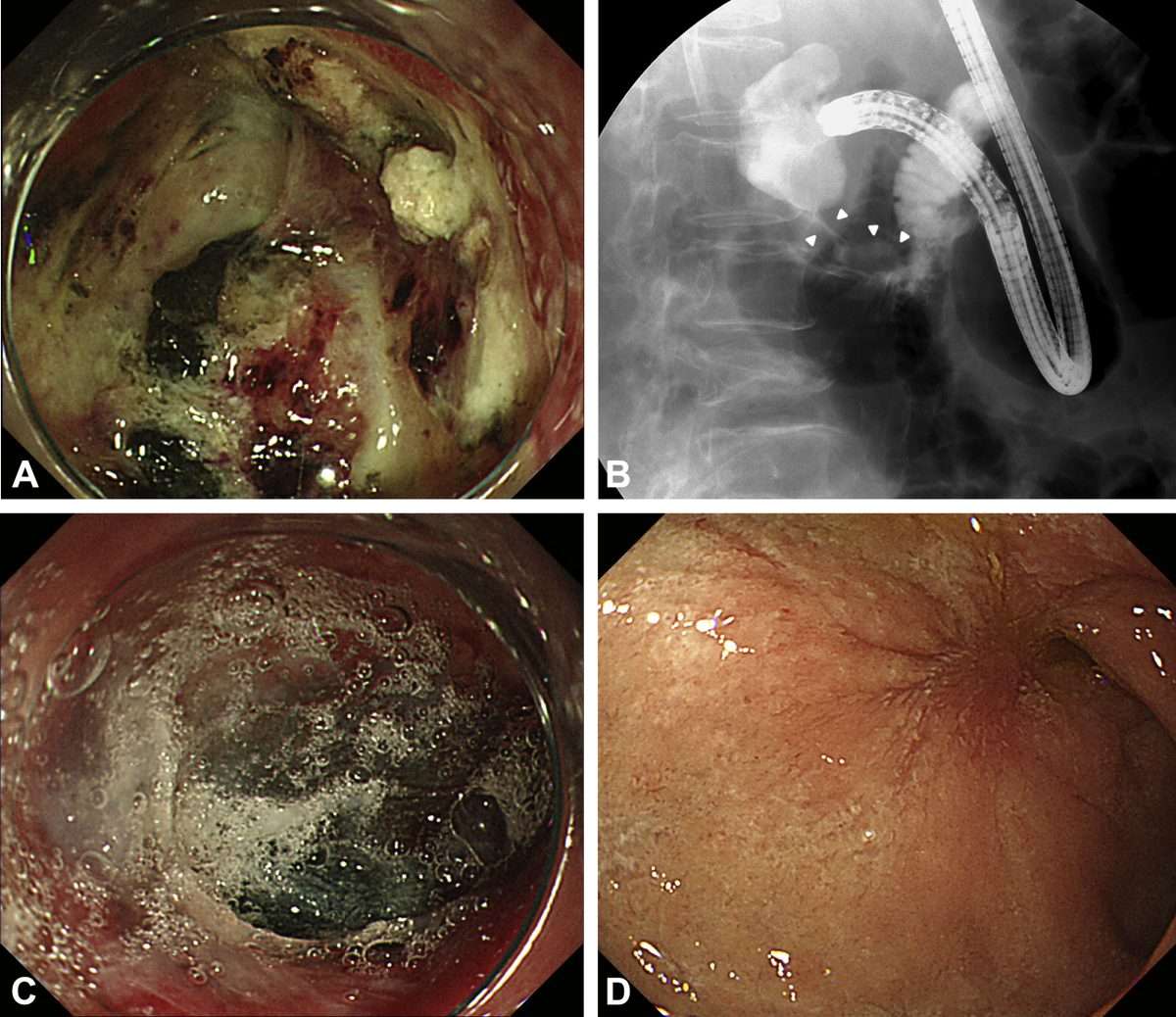 Successful treatment of a perforated duodenal ulcer with polyglycolic ...