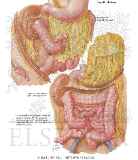 Surgical Treatment of Chronic Ulcerative Colitis: Stage II, Colectomy