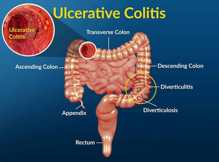 Symptoms Colitis, Ulcerative Colitis