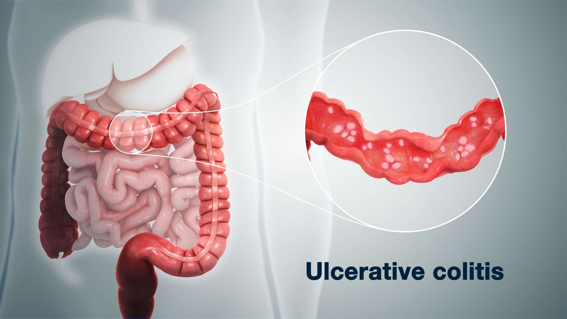 The 14 Dangerous Symptoms Of Ulcerative Colitis