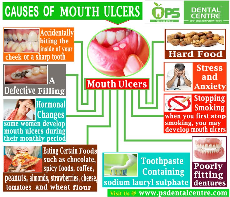 The 25+ best Causes of mouth ulcers ideas on Pinterest
