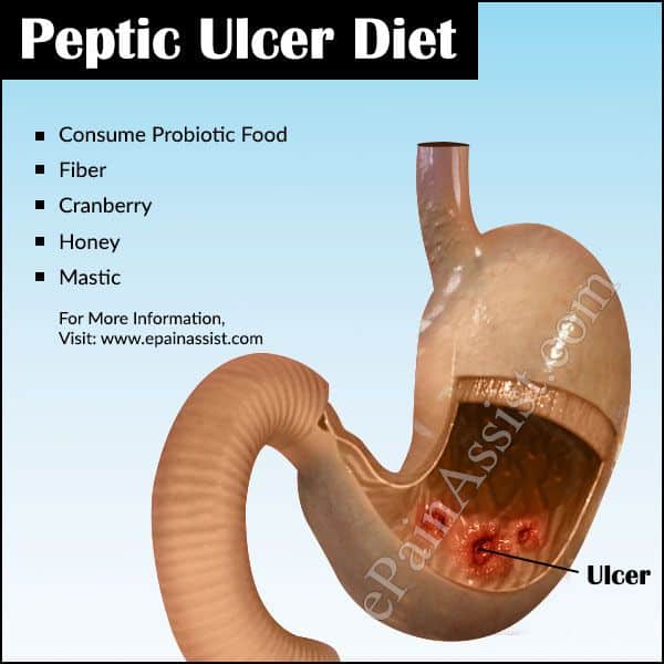 The 25+ best Peptic ulcer ideas on Pinterest
