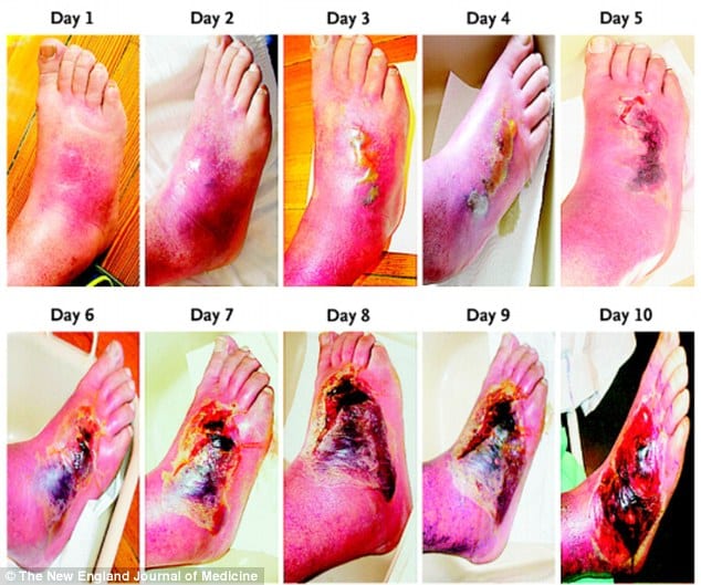 The shocking images that reveal what diabetes can do to your feet in ...