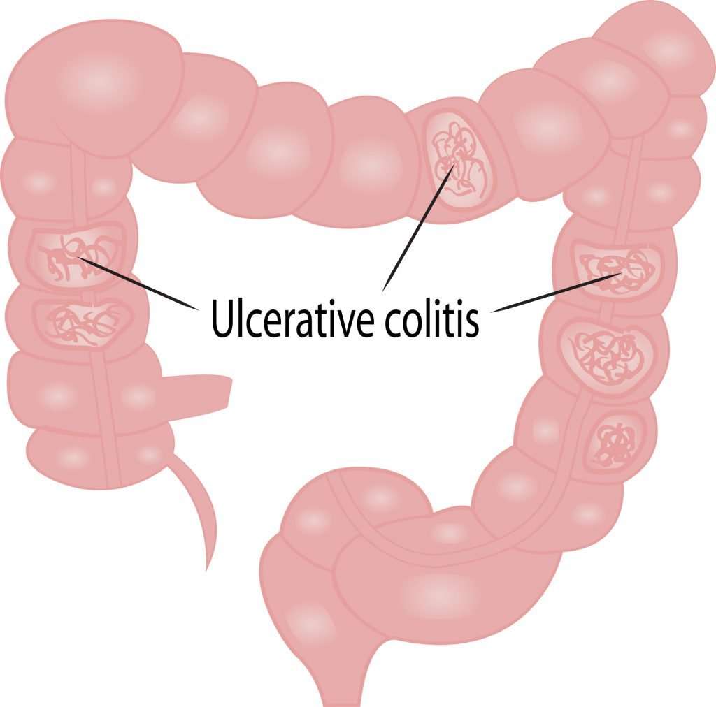 Therapy for Ulcerative Colitis
