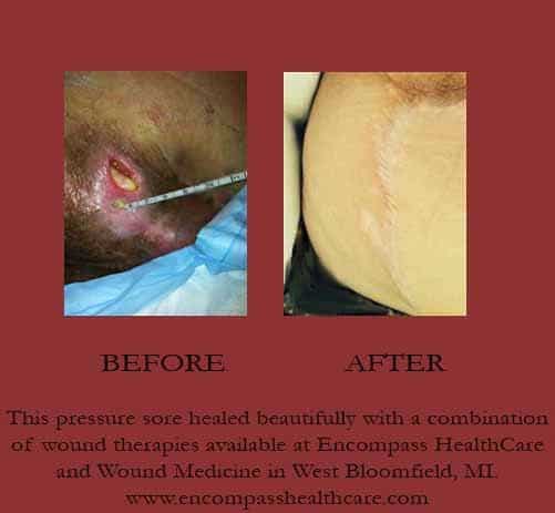 This pressure sore healed beautifully with a combination of wound ...