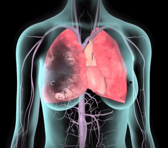 Tofacitinib (Xeljanz): Dangers of blood clots in the lungs and death ...