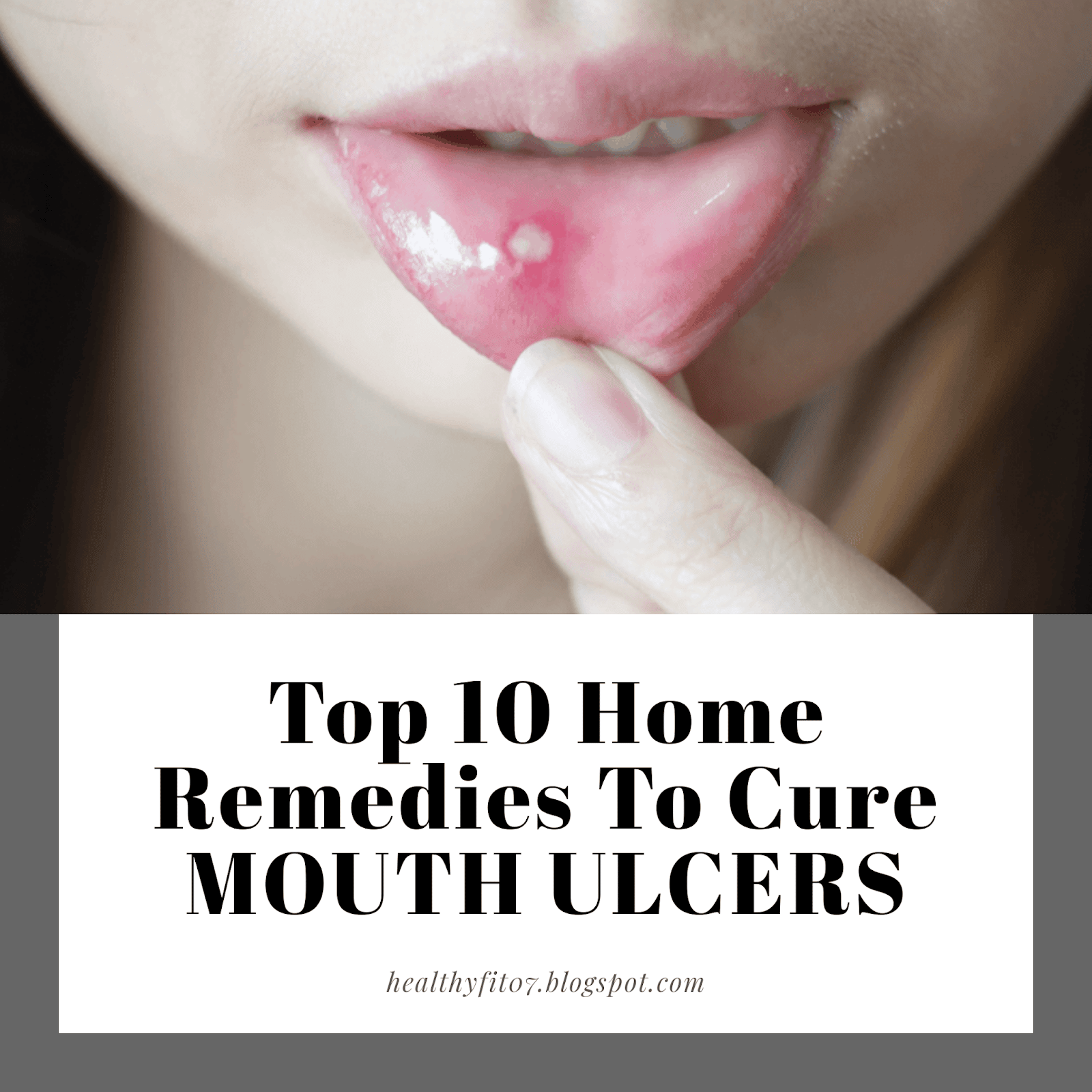 Top 10 Home Remedies To Cure MOUTH ULCERS