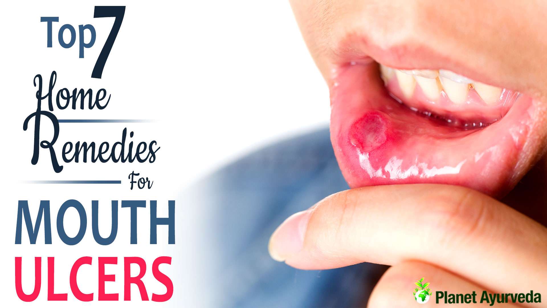 Top 7 Home Remedies for Mouth Ulcers: