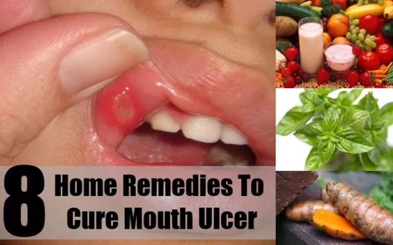 Treat Mouth Ulcer Naturally and Relish Your Food Without Pain