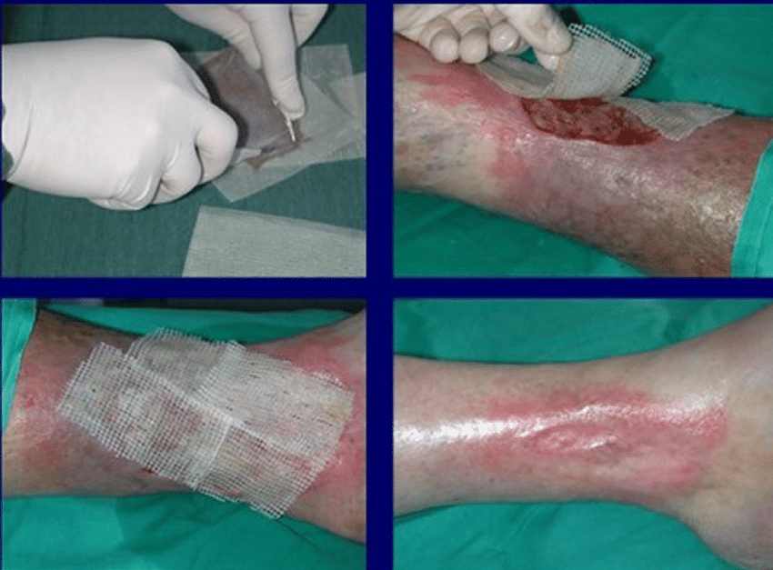 Treatment of a leg ulcer wound with cryopreserved unmeshed ...