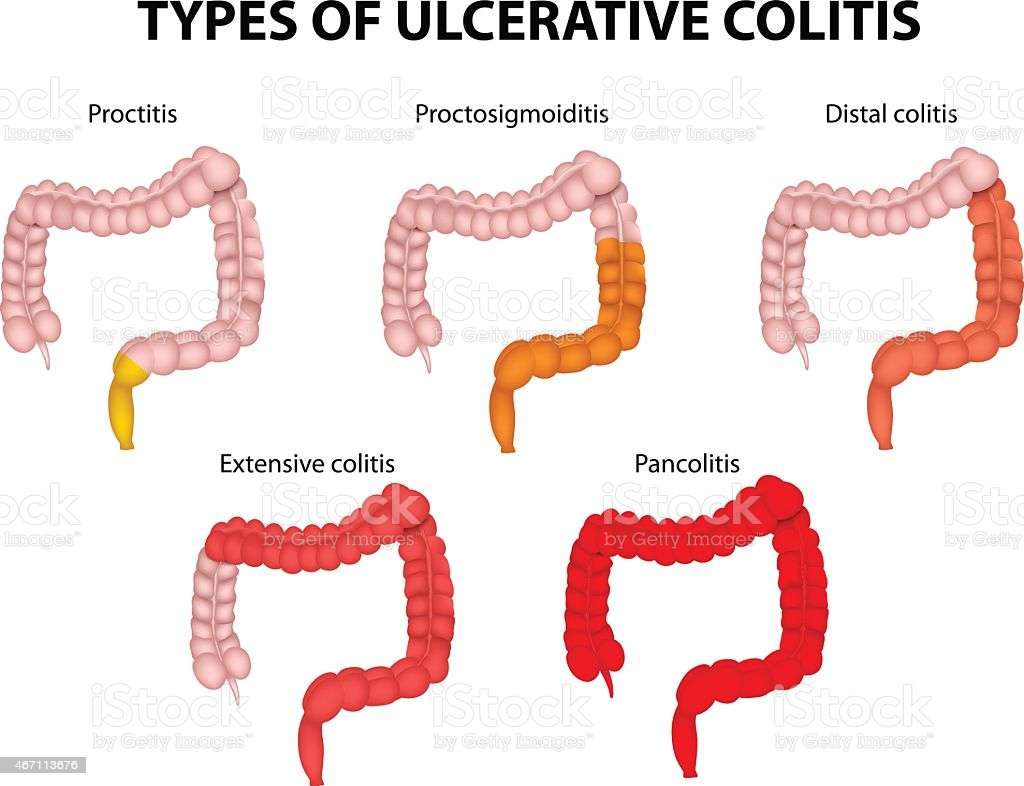 Types Of Ulcerative Colitis Stock Illustration