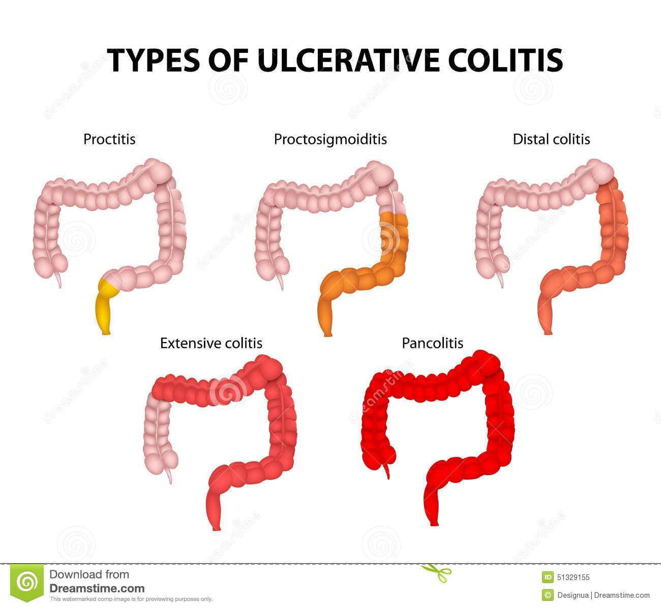 Types Of Ulcerative Colitis Stock Vector