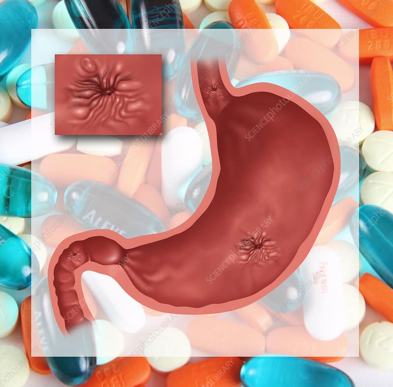 Ulcer from Painkiller Abuse, Illustration