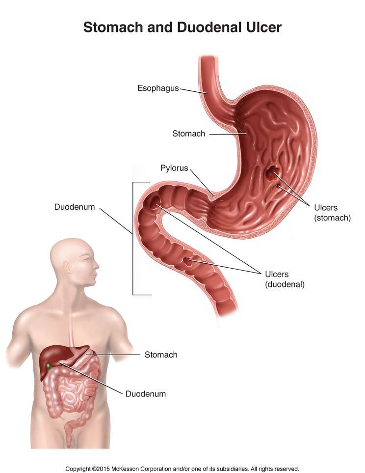 Ulcer in the Upper Intestine (Duodenal Ulcer)