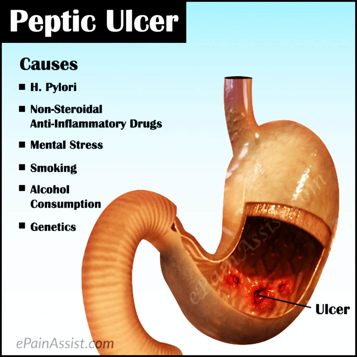 Ulcer No More