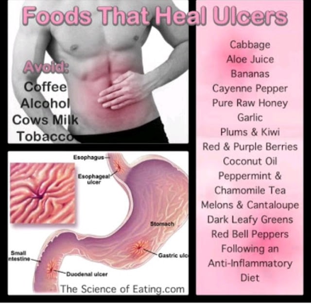 Ulcer Symptoms Diet and Natural Remedies