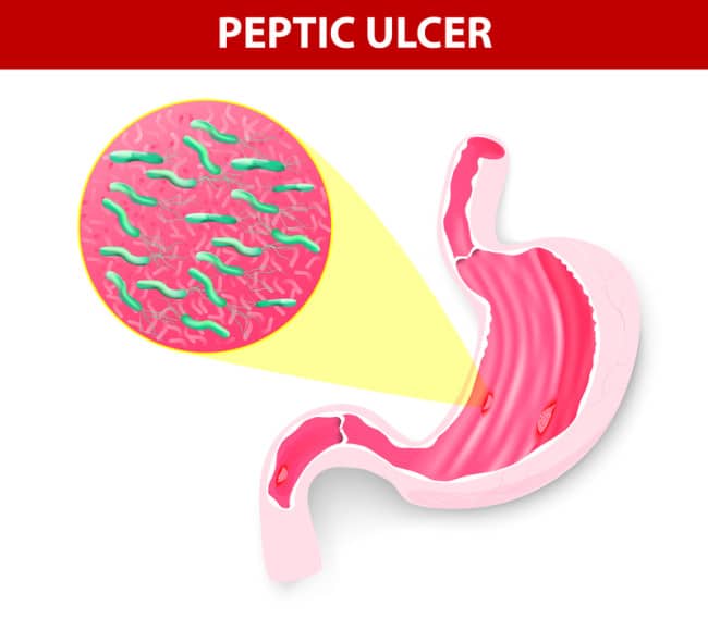 Ulcer Symptoms? Report Them to Your Doctor for Timely Treatment ...