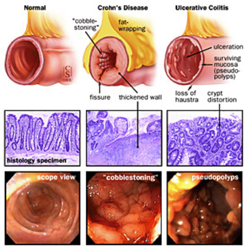 Ulcerative Colitis and Crohn