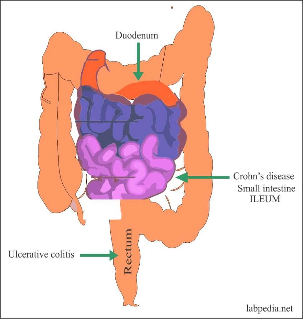 Ulcerative Colitis and Crohns Disease  Labpedia.net