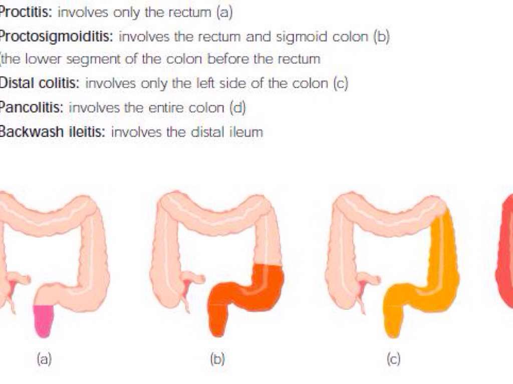 Ulcerative Colitis by Kelly Smith